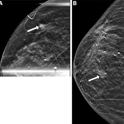 2023 01 11 00 50 4267 2023 01 10 Radiology Dcis 400 20230111002152