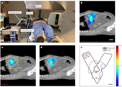 In vivo iRAI imaging versus the treatment plan on a patient. (a) A photograph of the iRAI imaging on a patient taken during RT. (b) The dose distribution of only the two static sagittal beams of the treatment plan with a liver mask fused onto the CT scan anatomy structure. Scale bar, 5 cm. (c) The iRAI measurement of dose with a liver mask fused onto the CT anatomy structure with the same position as in (b). The yellow dashed box indicates the field of view of the 2D matrix array. (d) Dose distribution (> 50%) of the treatment plan with a liver mask fused on the CT anatomy structure. (e) The 50 and 90% isodose lines in the iRAI measurement and the treatment plan. Scale bar, 2 cm. The red line (b-d) indicates the boundary of the liver. Images and caption courtesy of Nature Biotechnology through CC BY 4.0.