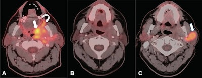 A 62-year-old man with a history of human papillomavirus-related oropharyngeal squamous cell carcinoma. (A) Axial fused image of FDG-PET and contrast-enhanced CT shows a large infiltrative tumor centered in the left palatine tonsil (straight arrow) extending to the left soft palate, retromolar trigone (curved arrow), medial pterygoid muscle, and left parotid gland. The patient underwent chemotherapy and radiation therapy. (B) Axial fused image of FDG-PET and contrast-enhanced CT performed 4 months after chemotherapy and radiation therapy shows marked reduction of metabolic activity. Mild residual soft-tissue fullness is present in the left parapharyngeal space, presumably representing posttreatment changes. (C) The patient underwent surveillance FDG-PET/CT, which shows a recurrent mass in the left parotid gland (arrow) with avid FDG uptake (maximum standardized uptake value, 24.5). The patient remained asymptomatic. The biopsy of the left parotid mass showed recurrent squamous cell carcinoma. Image and caption courtesy of Radiology.