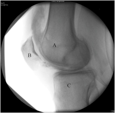 Postambulation contrast spread. A = Distal femur, B = Patella, C = Proximal tibia. Image courtesy of Interventional Pain Medicine through CC BY 4.0.