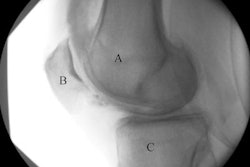 2023 01 13 18 41 8194 2023 01 13 Fluoroscopy Knee 20230113182446