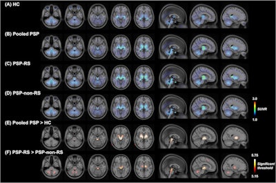 F-18 Florzolotau PET images of patients with progressive supranuclear palsy. The images illustrate F-18 Florzolotau uptake in the healthy control (HC) group (panel A), entire patient cohort (panel B), as well as in the PSP-Richardson's syndrome (RS) (panel C) and PSP-non-RS (panel D) groups. Compared with the HC group, patients with PSP showed significantly increased binding mainly in the pallido-nigro-luysian axis (panel E). While the patterns of tracer accumulation were similar in the two patient groups, the binding intensity was markedly lower in patients with PSP-non-RS (panel F). The color bars in panels A-D indicate standardized uptake value ratios (SUVR), whereas the color bar in panels E-F denote threshold values from the voxel-wise comparisons. Image and caption courtesy of the European Journal of Nuclear Medicine and Molecular Imaging through CC BY 4.0.