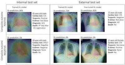 Gradient-weighted class activation maps of representative chest radiographs in (A) an 85-year-old man with acute coronary syndrome, (B) a 77-year-old man with aortic dissection, (C) a 39-year-old healthy man, and (D) a 27-year-old healthy woman. The maps show which parts of the images influenced deep-learning (DL) model predictions for the composite outcome. The color gradient shows the level of activation from that given area, where red indicates the highest activation, blue indicates the lowest activation, and no color indicates no activation. Areas of the heart and lungs contributed most to model predictions. Fine-tuning improved the diagnostic accuracy of the DL model and resulted in more relevant areas contributing to predictions. Image and caption courtesy of Radiology through CC BY 4.0.