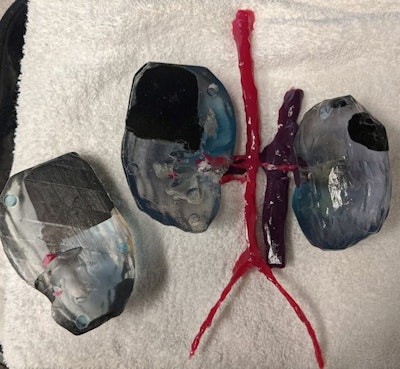 A 3D printed model depicts kidneys from a 32-month-old boy with multiple Wilms tumors. The model includes tumor (black), kidney (clear), collecting system (hollowed cavity), arteries (pink), and veins (purple). The model depicts how the tumors encroach on the kidney and collecting systems and allow for the kidney to be opened.