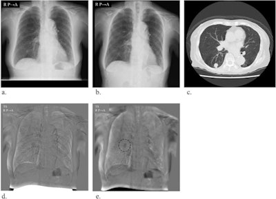 Images used for temporal subtraction (TS). (a) Previous radiograph. (b) Current radiograph. (c) CT image. (d) Conventional TS image. (e) Improved TS image acquired with bone suppression (BS) processing. The rib artifacts are reduced with BS-TS, and nodule areas are easily recognized. Image and caption courtesy of Heylion through CC BY 4.0.