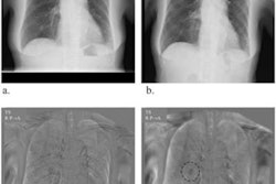 2023 01 19 17 19 9220 2023 01 20 Bone Suppression Digital X Ray 20230119173110