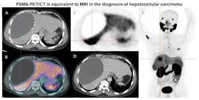 Representative imaging of a 58-year-old male of Asian ethnicity with previous resection of HCC in 2019. (A) low-dose CT, (B) fused PSMA-PET and low-dose CT, (C) PSMA-PET, (D) contrast-enhanced CT, (E) maximum intensity projection PSMA-PET. There is a hypodense fluid attenuation area within the right liver adjacent to surgical clips representing a known seroma/biloma. Ultrasound-guided biopsy of the PSMA avid lesion in hepatic segment 7 confirmed HCC. The patient commenced lenvatinib therapy with PSMA avid-likely bony metastatic disease in the right proximal humerus, T5 vertebral body, and left 3rd rib anterolaterally. The liver lesion was nonenhancing on contrast-enhanced CT. Image courtesy of Tomography through CC BY 4.0.
