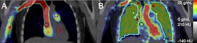 Representative fused coronal PET/CT images after injecting 207 MBq F-18 NOS with 2-cm diameter spherical blood pool search volumes of interest in the right atrium (black), pulmonary artery (blue), and left ventricle (red), with (A) PET-summed uptake 0-15 seconds post injection and (B) PET-summed 37 to 42 seconds post injection with lung volume of interest (cyan). Image and caption courtesy of the Journal of Nuclear Medicine through CC BY 4.0.