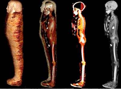 Digital unwrapping visualizations using CT. A series of 3D CT images of the mummy in the left lateral position show the steps of the virtual peeling of the bandages from left to right: the outer surface of the wrapped mummy (far left); partial unwrapping reveals the mummy within the bandages; the totally unwrapped mummy is viewed with a CT window level that highlights the soft tissues and embalming materials; the totally unwrapped mummy is viewed with a CT window level that shows the skeleton and dense amulets related to the mummy (far right). All images courtesy of Dr. Sahar Saleem.
