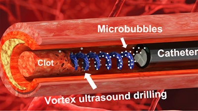 Researchers have developed a new tool and technique that uses 'vortex ultrasound' -- a sort of ultrasonic tornado -- to break down blood clots in the brain. The new approach worked more quickly than existing techniques to eliminate clots formed in an in vitro model of cerebral venous sinus thrombosis (CVST). Image courtesy of North Carolina State University.