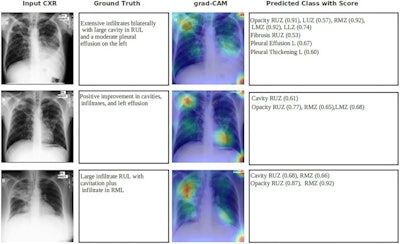 Grad-CAM image overlaid with tuberculosis patients in an external test set. Panel (input CXR) shows the chest x-ray images of patients. Panel (ground truth) shows the clinical readings associated with CXR. Panel (grad-CAM) shows the gradient-weighted class activation map overlaid with input CXR image. Panel (predicted class with score) shows the abnormality prediction with class score 0 to 1. RUZ right upper zone, RMZ right middle zone, LUZ left upper zone, LMZ left middle zone, LLZ left lower zone, L left lung. Image courtesy of Scientific Reports through CC BY 4.0.