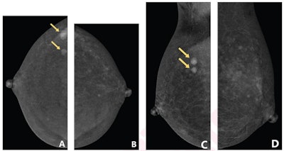 Contrast-enhanced mammography images show that the degree of background parenchymal enhancement (BPE) increases over time after contrast agent injection. (A) Craniocaudal view of the right breast shows mild BPE, whereas subsequently obtained (B) craniocaudal view of the left breast shows moderate BPE. Based on the first criteria reflecting only the first obtained view, the degree of BPE is classified as mild; based on the second criteria reflecting both obtained views, the degree of BPE is classified as moderate. Histopathologic assessment from subsequent biopsy showed that both masses were invasive ductal carcinoma.