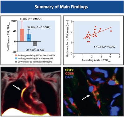 Patients with large vessel vasculitis (LVV) and recent atherosclerotic myocardial infarction (MI) underwent somatostatin receptor 2 (SST2) PET/MRI in a prospective observational cohort study. Arterial SST2 signal (arrow) measured by the maximum tissue-to-background ratio (TBRmax) using PET/MRI accurately differentiated patients with active/grumbling LVV from those with inactive LVV and recent MI, as well as control subjects. There was also a strong correlation between SST2 mean TBRmax and para-aortic thickening in LVV patients. SST2 expression was identified in macrophages (dashed arrow), pericytes, and perivascular adipocytes with arterial specimens from patients with LVV. Image courtesy of the Journal of the American College of Cardiology through CC BY 4.0.