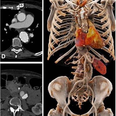 2023 01 27 19 07 4266 2023 01 26 Rad Cardiothor Imag Higashigaito Figure5 20230127191738