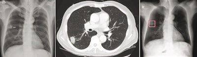 Chest radiograph images of a 59-year-old man with primary adenocarcinoma. Left, the nodule was visible on the chest radiograph (arrow); middle, the chest CT examination revealed a 27-mm lung adenocarcinoma in the right lower lobe (arrow); and right, on bone-suppressed chest radiographs created using the DLBS model, the algorithm correctly detected the true nodule (white box: ground truth, red box: DLBS). Image courtesy of JAMA Network Open through CC BY 4.0.