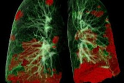 2020 12 15 00 57 6705 Ct Lung Damage Covid 19 400