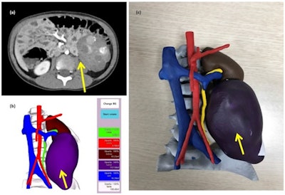 Computed tomography scan of a 4-year-old male patient with neuroblastoma (a), 3D reconstruction (b), and 3D printed model. Image and caption courtesy of Nature Scientific Reports under CC BY 4.0 International license.
