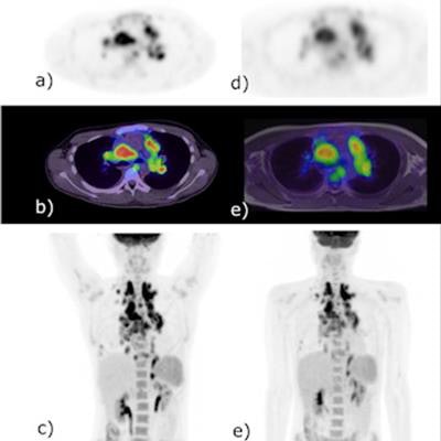 How Accurate Is a CT Scan for Lung Cancer?