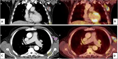 A 54-year-old male patient with Hodgkin's lymphoma treated with rituximab four months prior to vaccination. (A) Coronal and (C) axial contrast-enhanced CT images revealed multiple enlarged left axillary lymph nodes. (B) Coronal and (D) axial F-18 FDG-PET/CT images revealed enlarged and FDG-avid left axillary lymph nodes. At first, this was diagnosed as progression. Ultrasound-guided biopsy-revealed reactive follicular hyperplasia with no malignancy. Clinical history revealed that the patient received a second dose of the Pfizer-BioNTech COVID-19 vaccine in his left arm seven days before the PET/CT scan. Image courtesy of the Egyptian Journal of Radiology and Nuclear Medicine through CC BY 4.0.