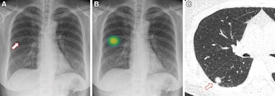 Images in a 60-year-old woman who underwent chest x-ray for health checkup purposes and was allocated to the artificial intelligence (AI) group. (A) Frontal chest x-ray shows a subtle nodular opacity (arrow) in the right middle lung zone. (B) The lesion was detected by the AI-based computer-aided detection software, with an abnormality probability of 81.1%. The designated radiologist reported this chest radiograph as positive. (C) Axial, noncontrast, low-dose chest CT scan shows a 1.1-cm solid nodule (arrow) in the right lower lobe. The patient underwent percutaneous needle biopsy, and the nodule was confirmed to be adenocarcinoma. Image and caption courtesy of Radiology.
