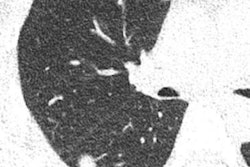 2023 02 07 01 35 3847 2023 02 07 Ai Lung Nodule 20230207011003