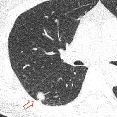 2023 02 07 01 35 3847 2023 02 07 Ai Lung Nodule 20230207011003
