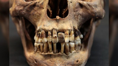Some of d'Alègre's teeth were wrapped together to secure them, while other teeth were pierced to allow the wire to pass through. Image courtesy of Rozenn Colleter, National Institute for Preventive Archeological Research.