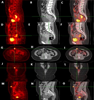 A 48-year-old female patient with a history of surgically treated colon cancer. Follow-up F-18 FDG PET/CT scanning (images A-F) revealed metabolic and morphologic regression of the previously noted nodular lesion in the recto-uterine pouch encroaching on the thickened rectal wall, with an SUVmax of 10.5 compared to 16.7. Other FDG-avid lesions (images G-O) beneath and within the anterior abdominal wall (currently measuring about 1.0 cm vs. 1.7 cm, with an SUVmax of 2.8 vs. 11.2). Image and caption courtesy of the Egyptian Journal of Radiology and Nuclear Medicine through CC BY 4.0.