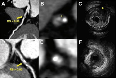 Representative images from two patients demonstrate the use of a radiomic signature to discriminate vulnerable plaques defined with intravascular ultrasound. (A-C) Images depict a vulnerable plaque with a high radiomic signature. (A) Image from coronary CT angiography (CCTA) shows a partially calcified plaque (arrow) with a radiomic signature value of 0.56 in the proximal left anterior descending artery. (B) Corresponding axial CCTA image shows the plaque with low-attenuation area (circle, 25 HU). (C) Corresponding intravascular ultrasound scan confirms the plaque as an attenuated plaque (*). (D-F) Images show a nonvulnerable plaque with low radiomic signature. (D, E) CCTA images show a partially calcified plaque (arrow in D) with radiomic signature value of 0.50 in the proximal left anterior descending artery. (F) Corresponding intravascular ultrasound scan confirms the plaque as a partially calcified plaque without echo attenuation and echolucent zone. High versus low radiomic signature lesion was defined using an optimal cut-off value of 0.53 (range, 0.46-0.58). Images and caption courtesy of RSNA.
