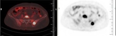 F-18 FDG-PET/CT showing FDG-avid lesion with osseous involvement in a patient with diffuse large B-cell lymphoma. Image courtesy of Cureus through CC BY 4.0.