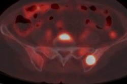2023 02 14 00 45 7085 2023 02 14 Lymphoma 20230214002336