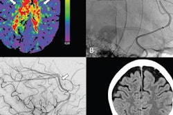 2023 02 14 16 22 2110 2023 02 14 Thrombectomy 20230214162620