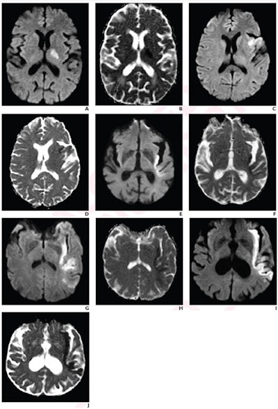 Images represent acute ischemic stroke patients with each PIRI score on a five-point scale. (A) Diffusion-weighted imaging (DWI) and (B) apparent diffusion coefficient (ADC) mapping show a 71-year-old patient with 0% insular ribbon infarction, score 0. (C) DWI and (D) ADC mapping show a 62-year-old patient with 25% insular ribbon infarction, score 1. (E) DWI and (F) ADC mapping show a 90-year-old with 50% insular ribbon infarction, score 2. (G) DWI and (H) ADC mapping show a 59-year-old with 75% insular ribbon infarction, score 3. (I) DWI and (J) ADC mapping show a 69-year-old with 100% insular ribbon infarction, score 4. Images courtesy of the American Roentgen Ray Society.