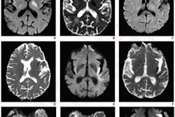 2023 02 15 18 45 5587 2023 02 15 Piri Mri Stroke 20230215181716