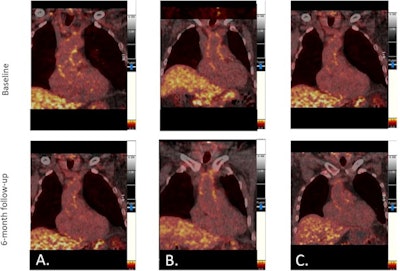 FDG-PET images showing change in ascending aorta FDG radiotracer uptake from baseline to six-month follow-up in (A) patients with psoriatic arthritis and/or psoriasis on biologic agents, (B) patients with psoriasis on nonbiologic agents, and (C) control patients with non-inflammatory arthritis. Image courtesy of the Journal of Nuclear Cardiology through CC BY 4.0.