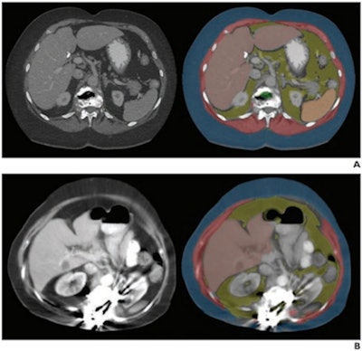 Axial images at L1 level, without (left) and with (right) segmentation overlay. Red indicates skeletal muscle, green indicates trabecular bone, yellow indicates visceral fat, and blue indicates subcutaneous fat. Segmented regions also include liver (beige) and spleen (orange), which were not evaluated as part of present analysis. (A) 78-year-old woman who underwent abdominopelvic CT at an outside institution. Bone tool returned L1 vertebral body bone attenuation of -146 Hounsfield units (HU), outside of reference range. Thus, the tool was deemed technical failure for bone tool. Failure was attributed to volume averaging of vacuum phenomenon within slice. (B) 64-year-old woman who underwent abdominopelvic CT at an outside institution. Bone tool returned vertebral body bone attenuation of -10,000 HU (default value for segmentation failure detected by tool), outside of reference range. Thus, the tool was deemed technical failure for bone tool. Failure was attributed to the presence of spinal fusion hardware. Images and caption courtesy of the American Journal of Roentgenology.