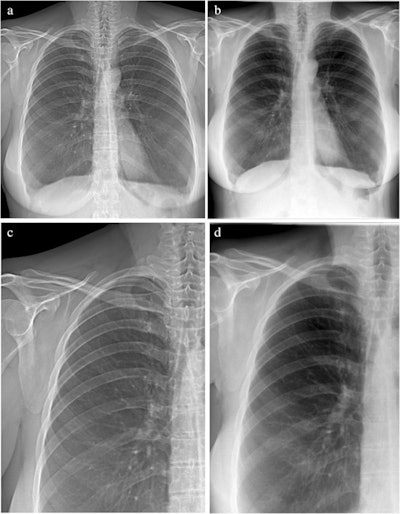 Attenuation images of a 42-year-old woman with COPD (GOLD III). (A) Attenuation image acquired with the prototype. (B) Attenuation image acquired at the commercial system. Images C and D show enlarged extracts from A and B, respectively. Image courtesy of European Radiology through CC BY 4.0.