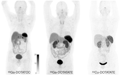 Normal biodistribution in patients of the radiotracers Ga-68 DOTATOC, Ga-68 DOTATATE, and Cu-64 DOTATATE. Image courtesy of the Journal of Nuclear Medicine.