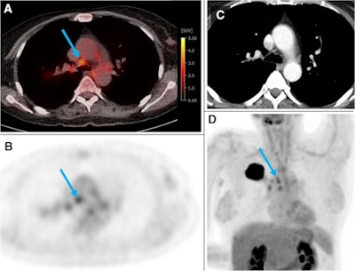 A 54-year-old woman from the training and test cohort with a G2 adenocarcinoma of the right upper lobe (44 mm). Several hilar and mediastinal lymph nodes showed higher F-18 FDG uptake than the normal liver (PET score of 3). The blue arrow depicts an N2 paratracheal lymph node with 7 mm short axis and SUVmax of 3.5. Based on visual assessment, N2 disease would be suspected in this case. According to the gradient boosting classifier model, the probability of N2/3 is only 0.17. The patient was confirmed to be N0 by ultrasound-guided transbronchial needle biopsy of the ipsilateral hilar, paratracheal, and subcarinal LNs. Image courtesy of the European Journal of Nuclear Medicine and Molecular Imaging through CC BY 4.0.
