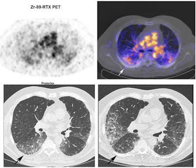 Zr-89 rituximab PET/CT and HRCT of a 65-year-old patient with fibrotic nonspecific interstitial pneumonia-associated rheumatoid arthritis (case 3). Zr-89 rituximab PET (top left) axial PET image (top right) fused Zr-89 rituximab PET/CT. HRCT (bottom left) at baseline of PET and HRCT after one year (bottom right). Matching of the axial view between the PET/CT and HRCT is not exactly possible since the HRCT is performed with an inspiration command and the PET/CT is in the resting state. The Zr-89 rituximab activity is more focused in the lower lobes. This central area on Zr-89 rituximab correlates more with the HRCT ground glass; see, for example, the right lower lobe ground-glass area. The HRCT after one year post rituximab did not show any ground glass in this area. However, new ground-glass areas emerged on the HRCT in the lower upper lobes. The patient remained stable in pulmonary function. Image courtesy of the European Journal of Nuclear Medicine and Molecular Imaging through CC BY 4.0.