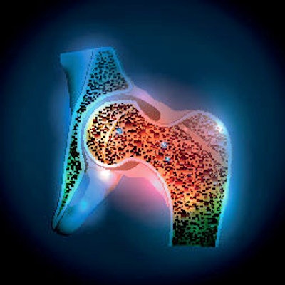 2021 04 06 21 52 3854 Osteoporosis Hip Joint 400