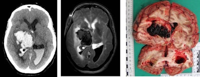Brain hemorrhage due to hypertension or vessel anomalies is a natural death -- this finding in the postmortem imaging can allow such cases to be closed without open invasive autopsy. Images courtesy of Dr. Michael Thali.