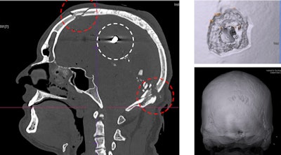 Gunshot injuries can be perfectly visualizised in 3D for court cases. Here, images show a gunshot with entrance wound in the neck area and bullet ricochet effect in the inner frontal part of the skull.