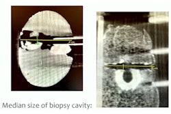 2023 03 02 16 24 6988 2023 03 01 Ecr Cbct Breast Biopsy 400