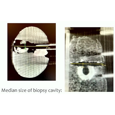 2023 03 02 16 24 6988 2023 03 01 Ecr Cbct Breast Biopsy 400