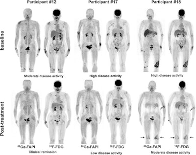 Pre- and posttreatment PET/CT in three participants with different responses undergoing tight control treatment. Participant #12 is a 55-year-old woman with a one-month history of rheumatoid arthritis (RA) who was treated with methotrexate, etoricoxib, tripterygium wilfordii, and iguratimod. Participant #17 is a 53-year-old woman with a one-year history of RA who was treated with methotrexate and etanercept. Participant #18 is a 55-year-old woman with a 19-month history of RA who was treated with methotrexate, etanercept, and tripterygium wilfordii. There is residual active uptake of Ga-68 FAPI and F-18 FDG radiotracers in three major joints six months after treatment in participant #18 (arrows). Image courtesy of Radiology.