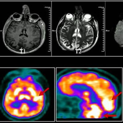 Use of total-body PET imaging to identify deep-tissue SARS-CoV-2