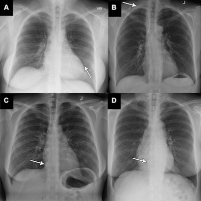 Four examples (out of a total of nine) of x-rays classified as 'abnormal, unremarkable' by the reference standard but as 'normal' by the AI tool. All x-rays show very subtle and unremarkable findings and were all classified as normal by the clinical radiologic report as well. (A) X-ray in a 58-year-old woman with very discrete linear atelectasis in the lingula segment of the left upper lobe (arrow). (B) X-ray of a 61-year-old woman shows presence of a cervical rib on the right side (arrow). (C, D) Images in a 48-year-old woman (C) and a 64-year-old woman (D) show very subtle degeneration in the spine with osteophytes in lower thoracic segments (arrow). Image courtesy of Radiology.