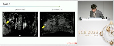 Dok Bong Yeo from Kyungpook National University Hospital in South Korea presented his team's findings at ECR 2023, showing that dual-layer CT has high concordance with MRI when it comes to breast cancer staging. The images shown depict how this CT method also detects suspicious breast lesions prior to treatment in comparison to conventional MRI. Images courtesy of Dok Bong Yeo and the European Society of Radiology.