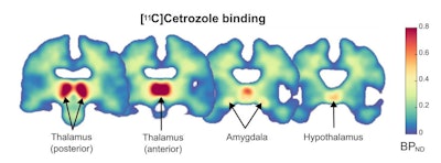 Distribution of C-11 cetrozole binding in the brain of healthy women. Parametric map of C-11 cetrozole non-displaceable binding potential (BPND), averaged across all participants (N=10). Coronal sections of the brain (y = -24, -18, -6, -2) show the highest aromatase availability in the thalamus, followed by the amygdala and hypothalamus. Image courtesy of Comprehensive Psychiatry through CC BY 4.0.